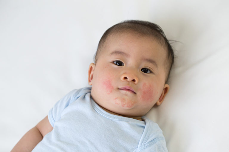 Baby-Akne und andere neugeborene Gesichtsausschläge